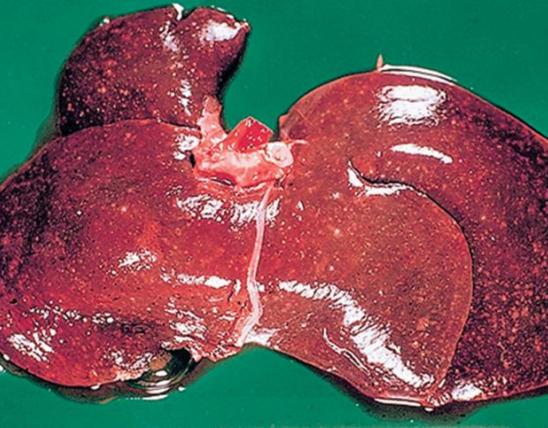 Infected liver